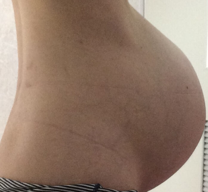 双子妊娠35週のおなか写真