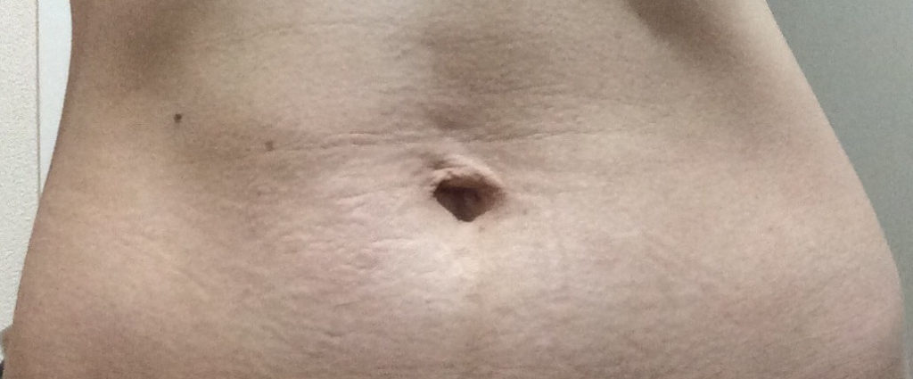 妊娠線産後１年のお腹