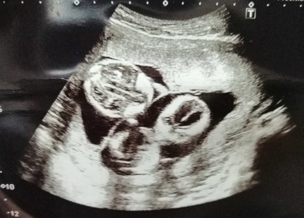 双子妊娠5ヶ月のエコー