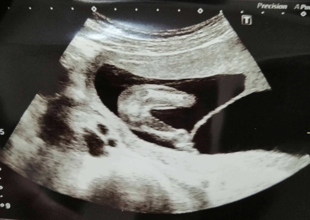 双子妊娠5ヶ月のエコー写真