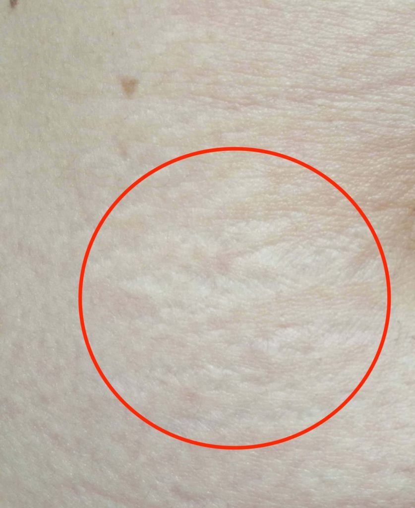 妊娠線産後の経過説明写真⑤